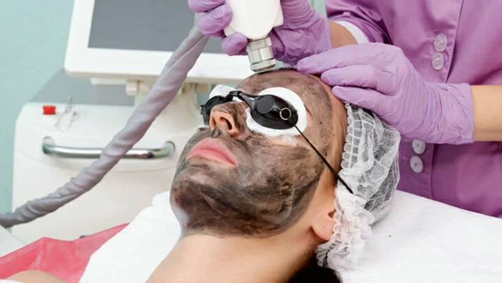 Carbon Laser Treatment